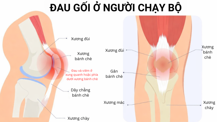 Đau đầu gối khi chạy bộ: Nguyên nhân và lộ trình phục hồi đúng cách