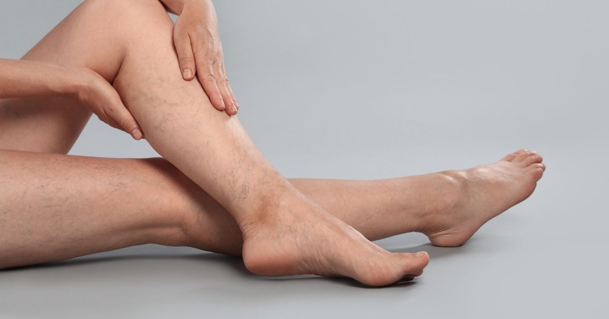 Giãn tĩnh mạch chân có nên chạy bộ không? Nguyên tắc chạy bộ an toàn cho runner