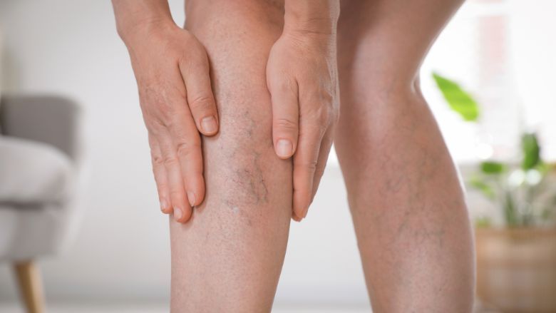 Giãn tĩnh mạch chân có nên chạy bộ không là điều nhiều runner thắc mắc