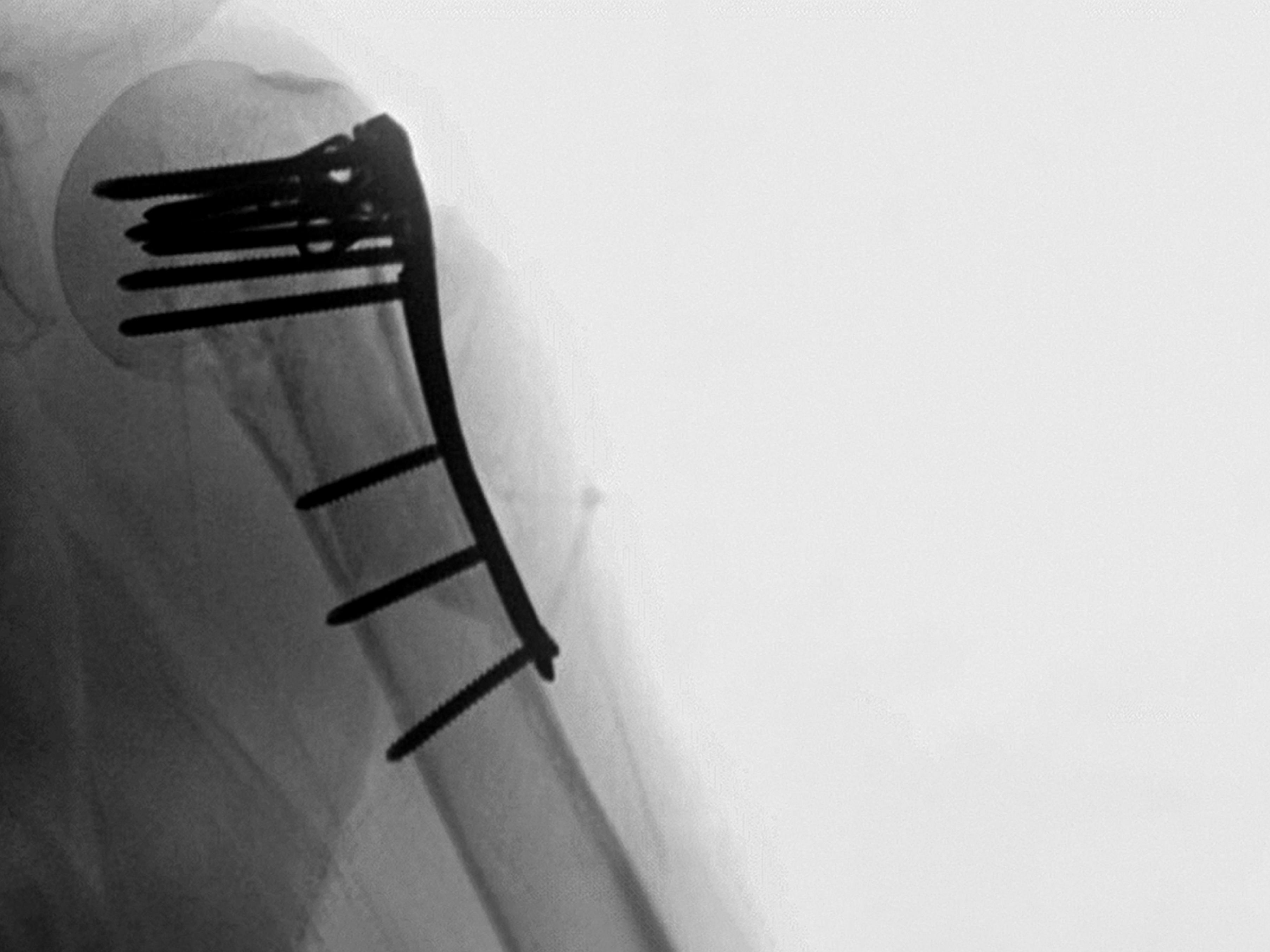 TAMINA fibular strut augmentation