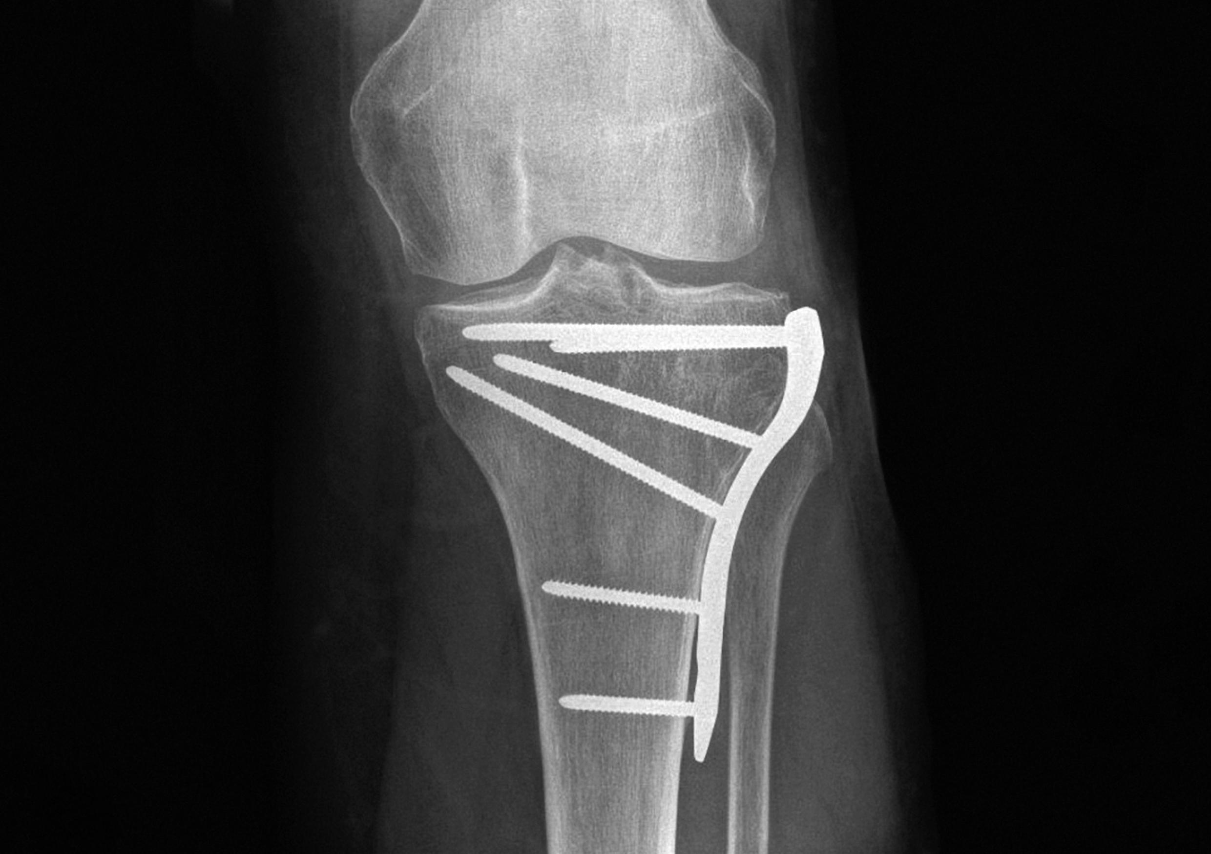 One-stage and two-stage procedures on bilateral proximal tibia fractures
