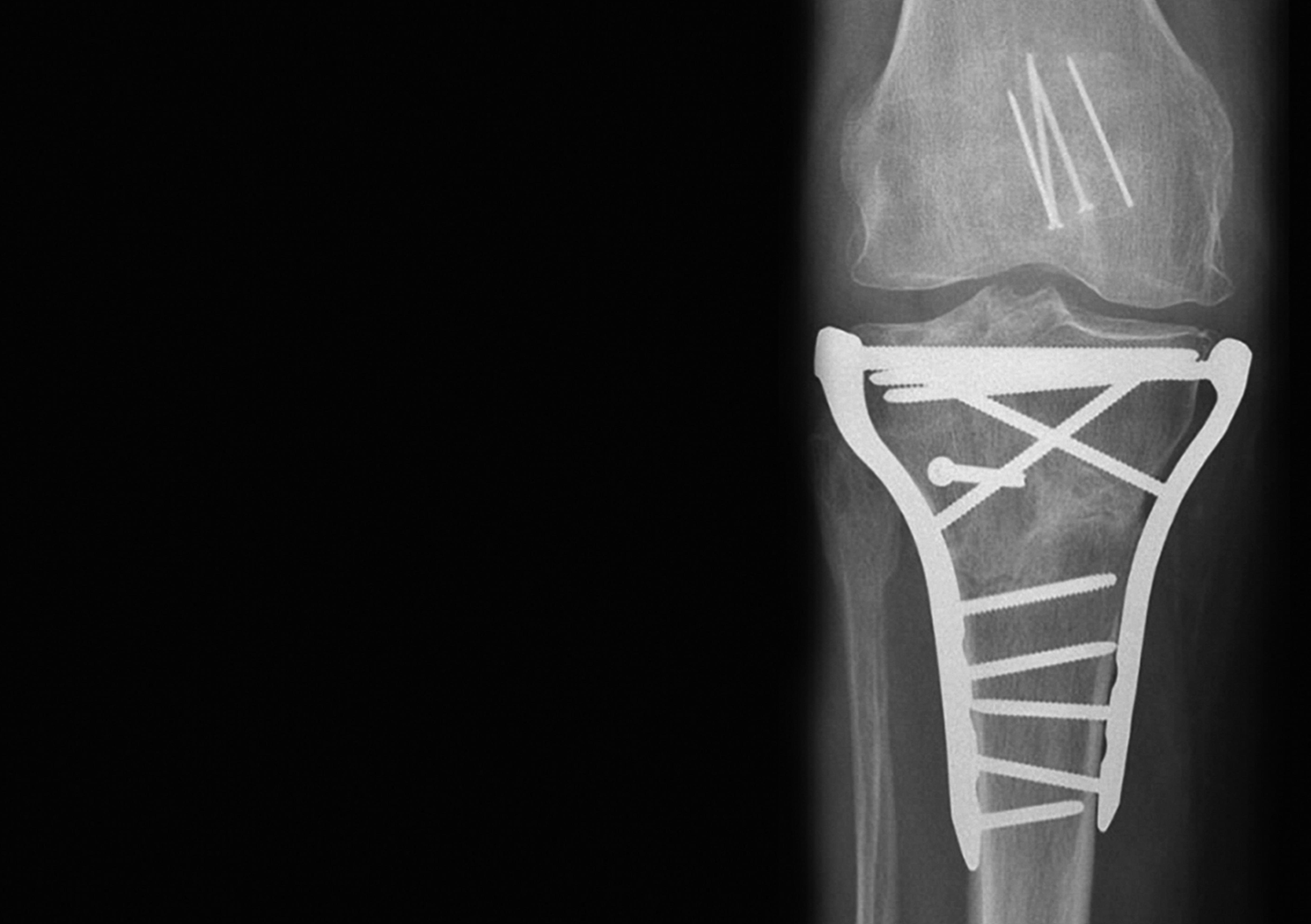 Complex fracture of the right proximal tibia 