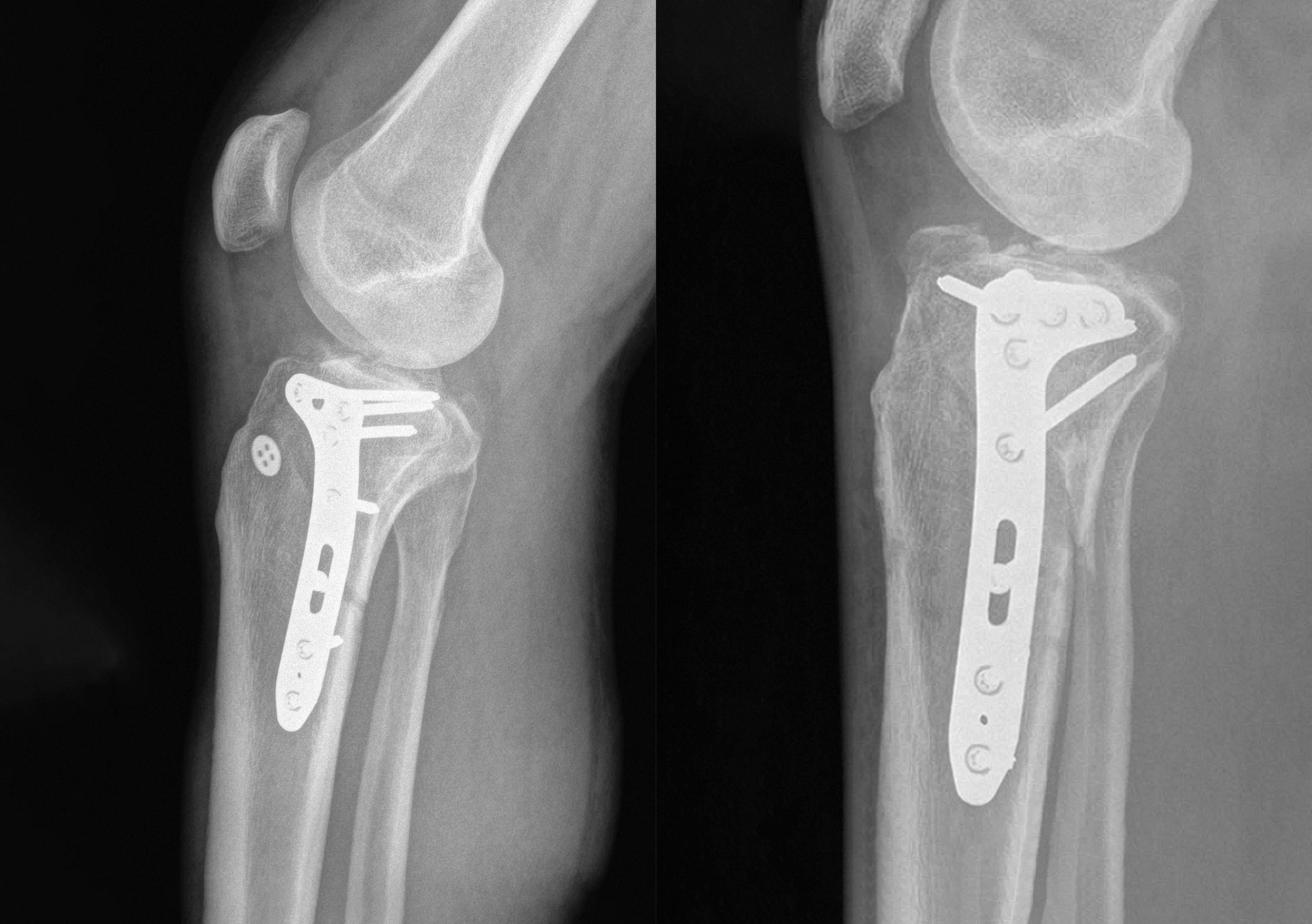 POYA Cases X-ray