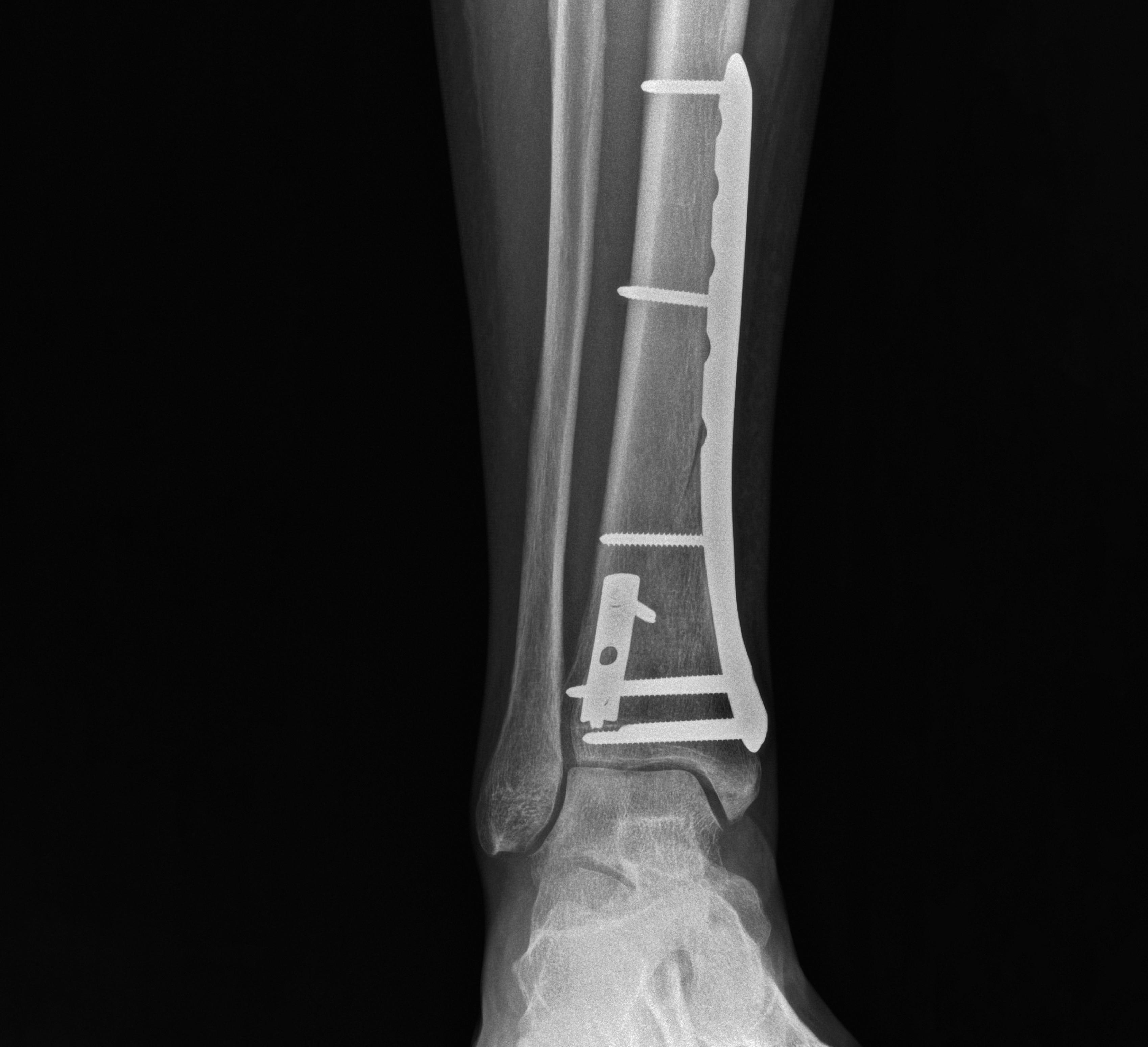 SALTI x-ray crop