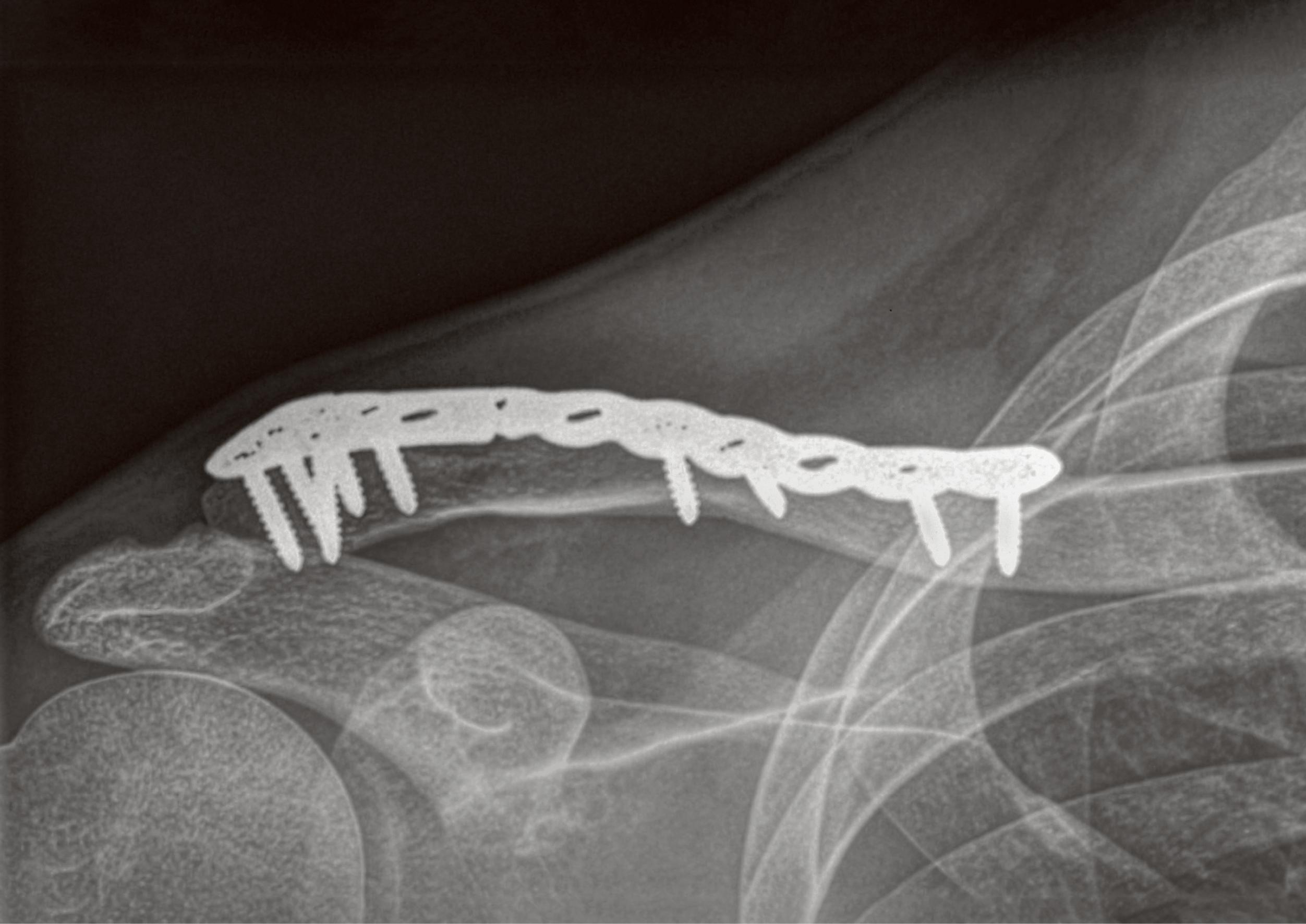 Cascella Lateral 3.5mm Superior Clavicle Plate by Bonebridge