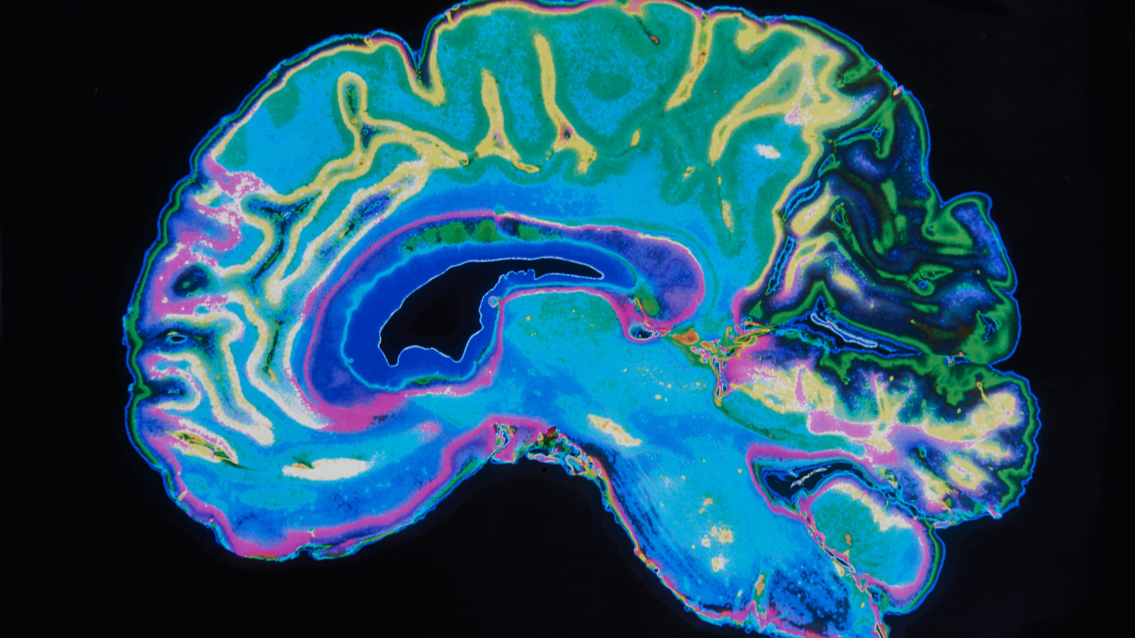 Grafisk scanning af en hjerne 