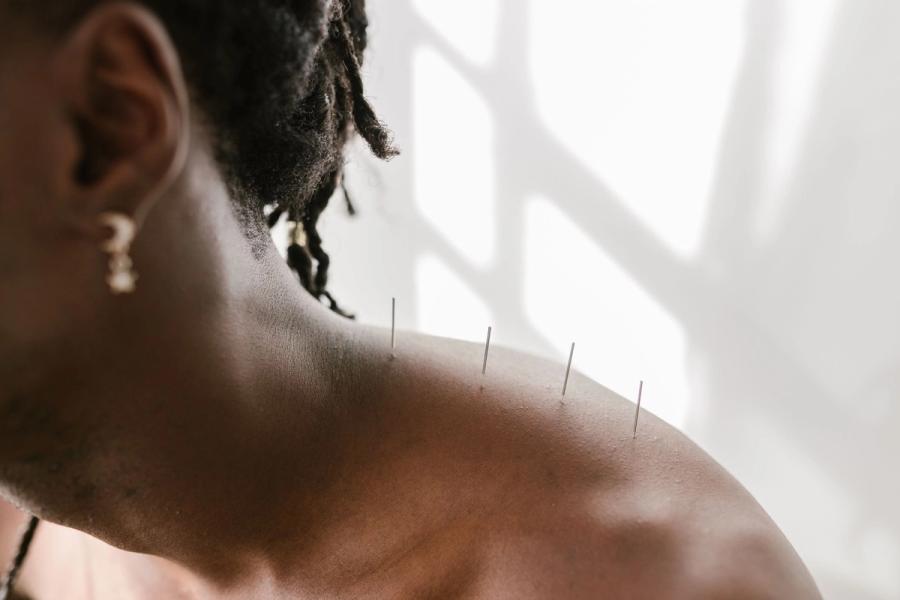 Thin dry needles placed along the muscles of a patient’s neck and shoulder