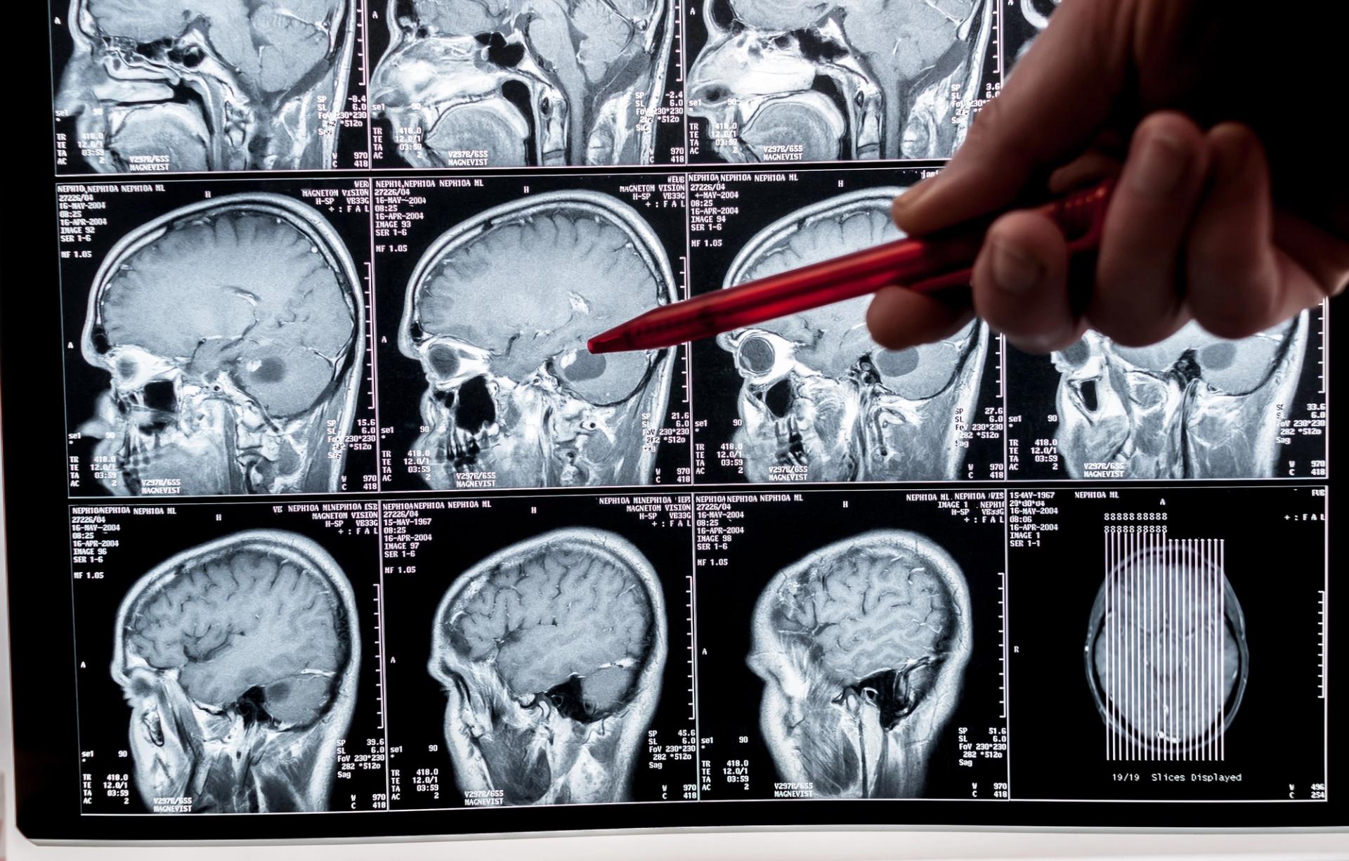 A red pen pointing to an image of multiple brain x-rays