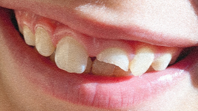 Photo of a smiling mouth with a chipped front tooth