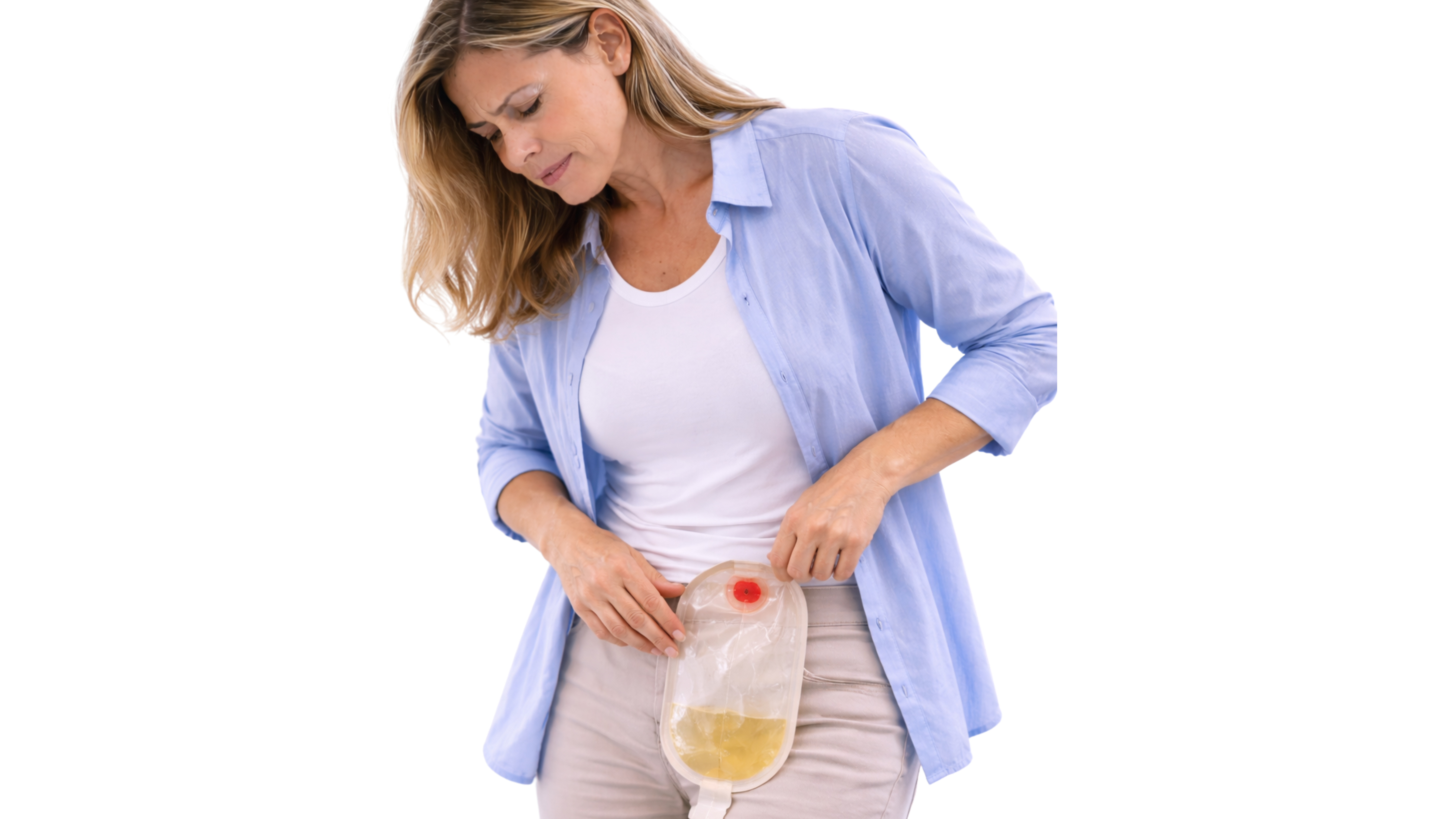 Urinary Diversion