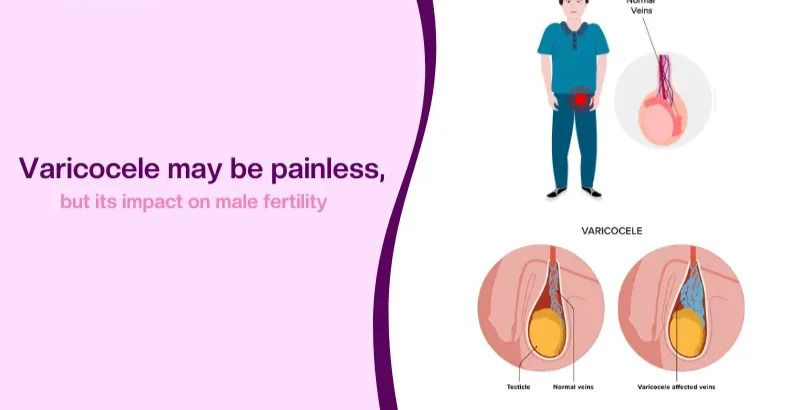 varicocele veins