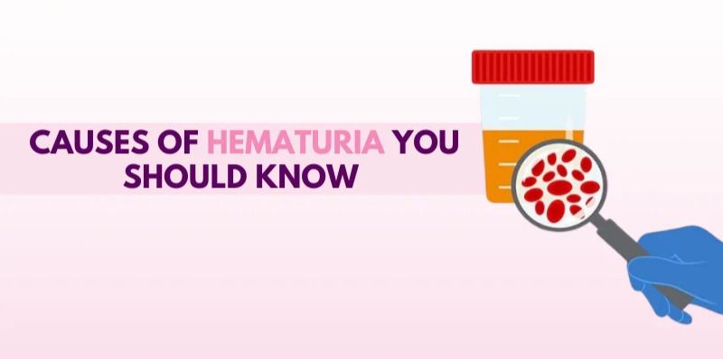 Hematuria