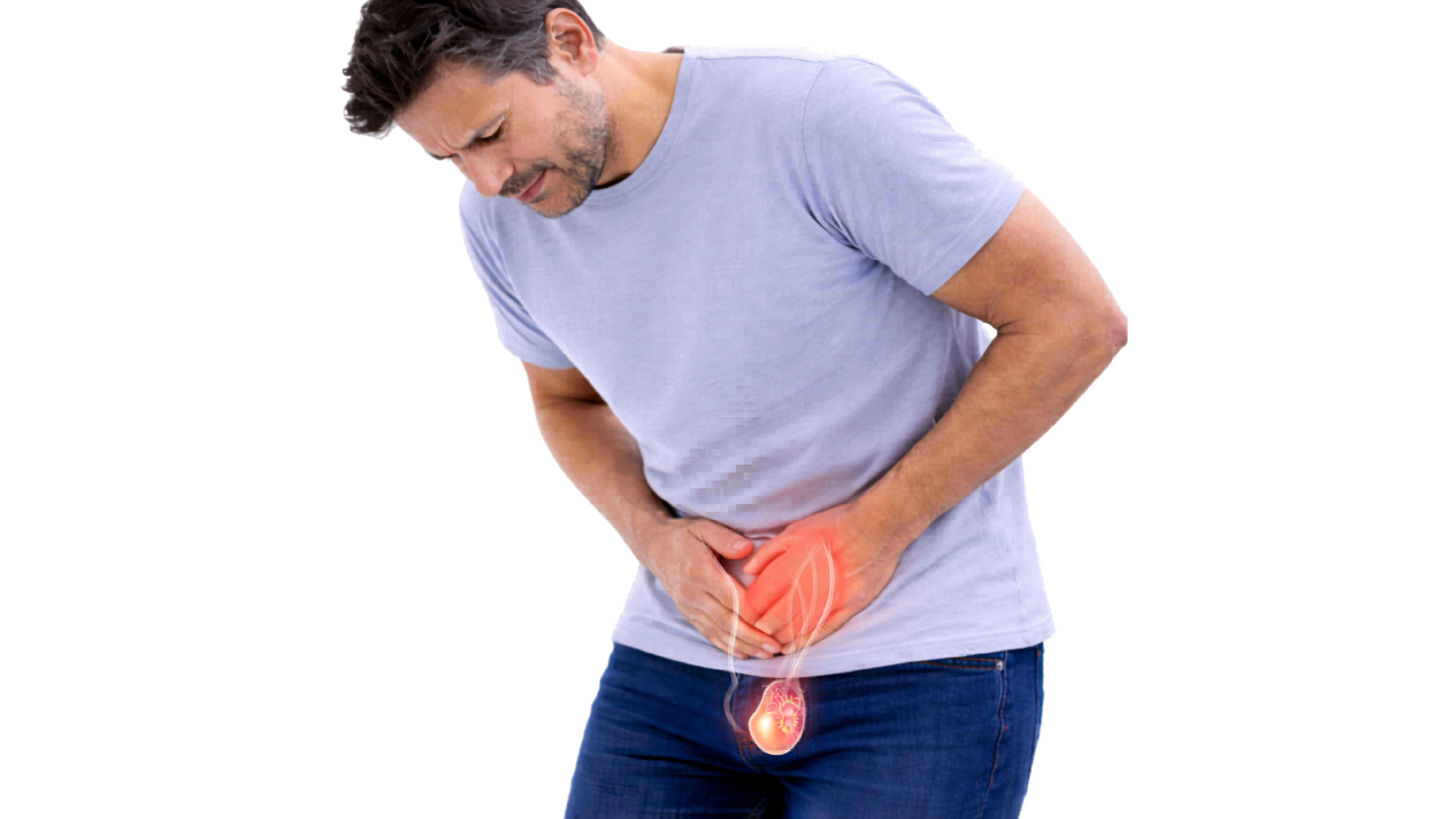 Varicocele