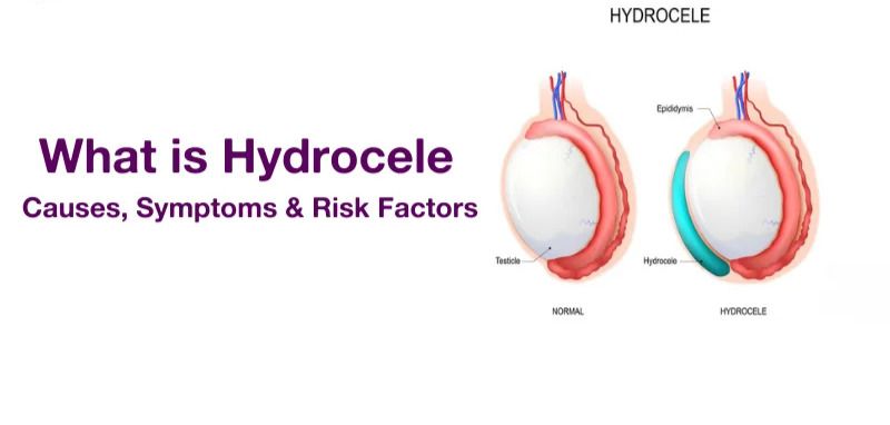 Hydrocele