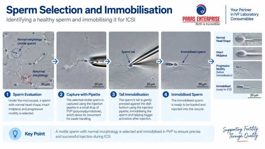 Sperm selection and immobilisation for ICSI showing normal sperm morphology, sperm capture with an injection pipette, tail immobilisation, and immobilised sperm ready for injection