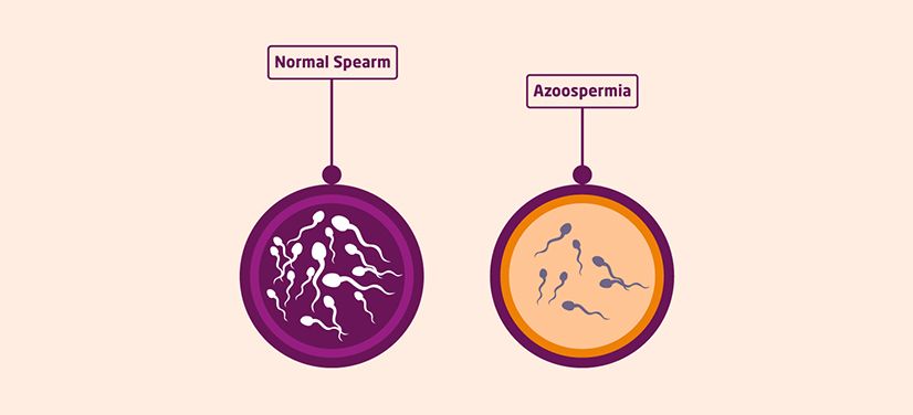 Comparison of Azoospermia, Oligospermia, and Asthenozospermia