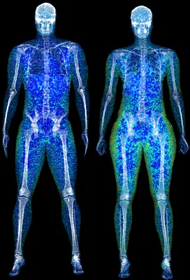 dexa scan body composition body fat