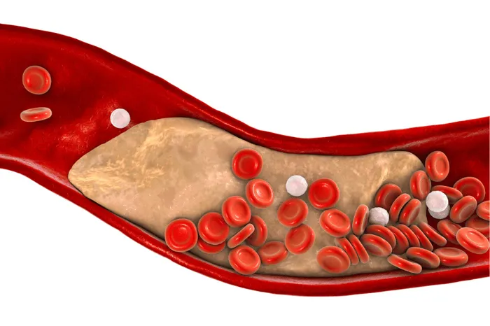 blocked coronary artery requiring angioplasty / stent procedure