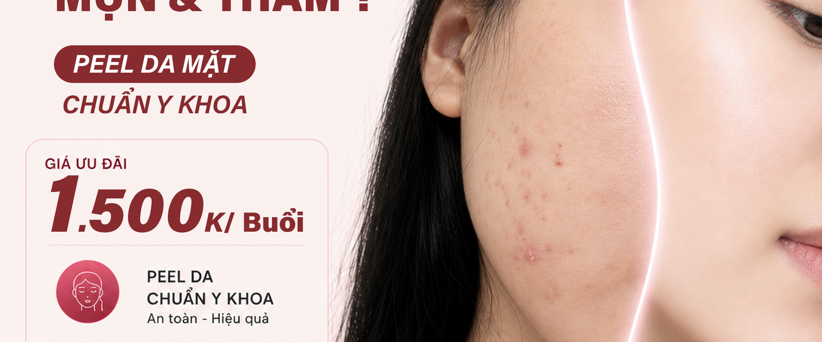 Thanh Lọc Làn Da – Sạch Mụn, Sáng Mịn