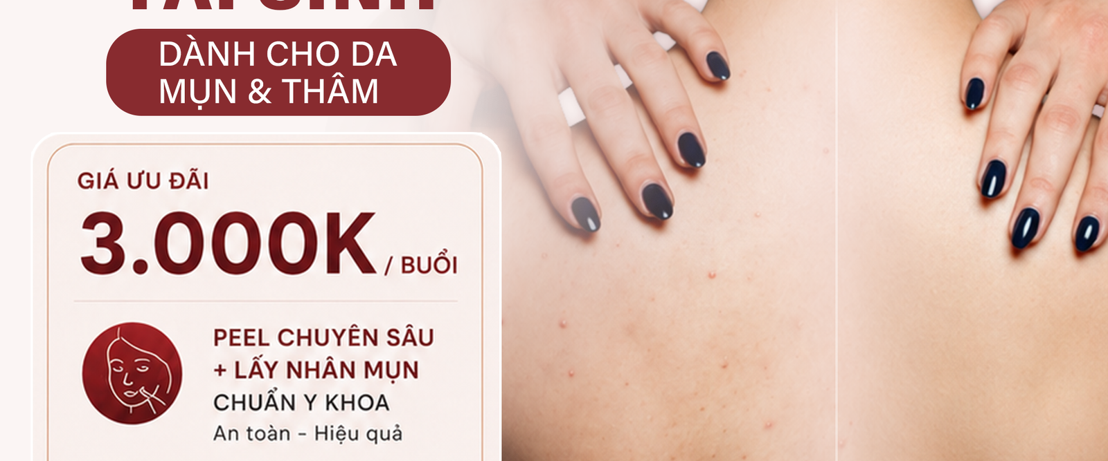 lấy mụn Tạm Biệt Mụn Lưng – Tự Tin Khoe Lưng Mịn