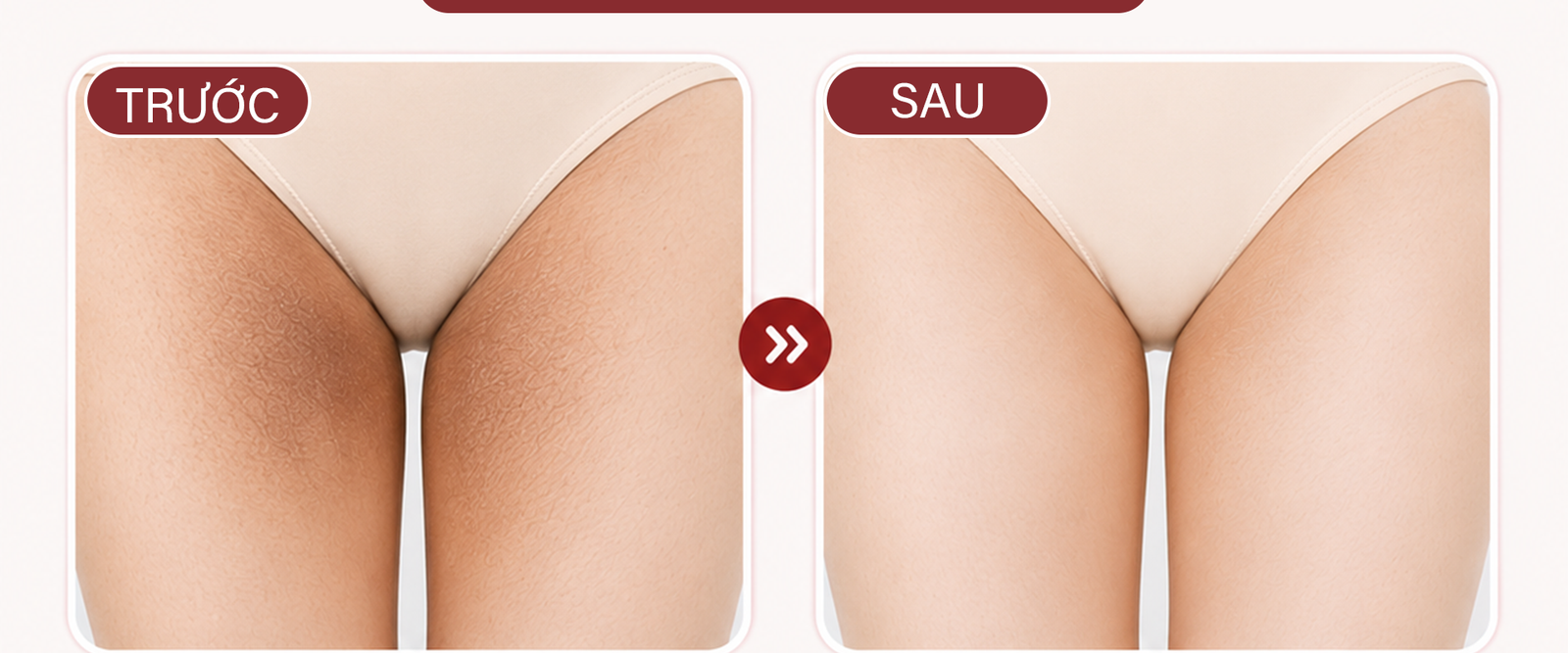 Vùng Bẹn Sáng Mịn – Tự Tin & Đều Màu Hơn
