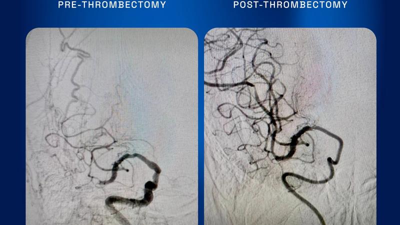 Stent-Retriever Anchoring Technique in Tortuous Anatomy Thrombectomy