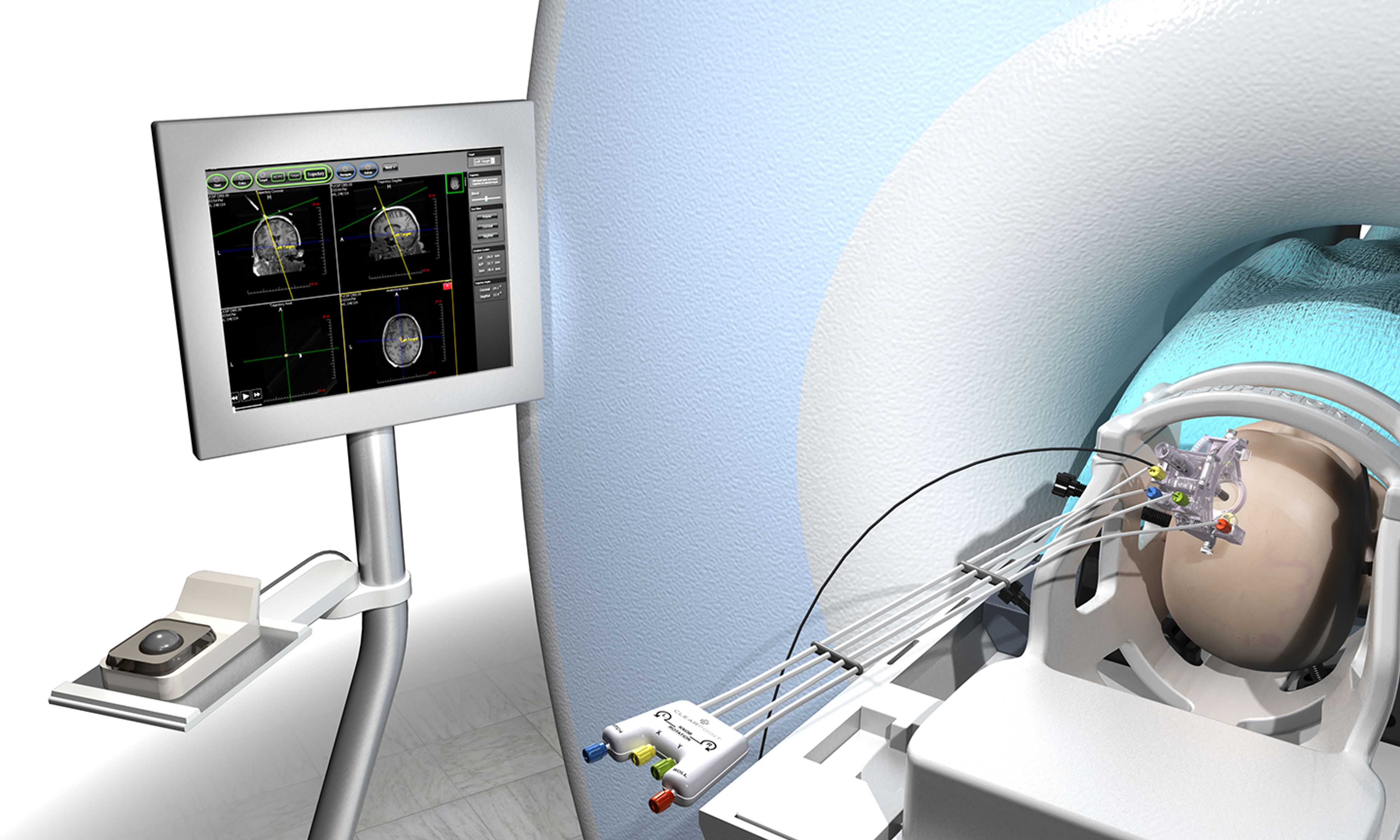 Rendering of the surgical device being used on a patient in a CT machine, with a monitor of the patient’s brain activity next to the CT machine