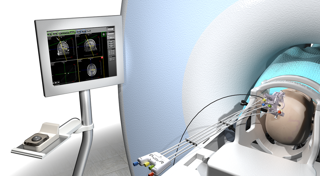 Rendering of the surgical device being used on a patient in a CT machine, with a monitor of the patient’s brain activity next to the CT machine