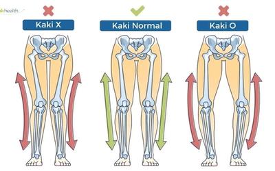 Perbedaan Kaki O dan Kaki X serta Cara Menyembuhkannya