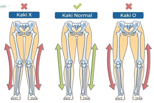 Perbedaan Kaki O dan Kaki X serta Cara Menyembuhkannya
