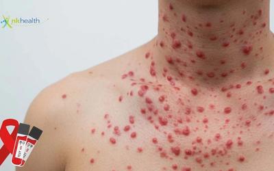 Tanda Tanda HIV pada Pria yang Perlu Diketahui