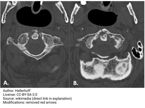 Two transverse CT scans of the cervical spine: A) normal, B) metastatic lung cancer.