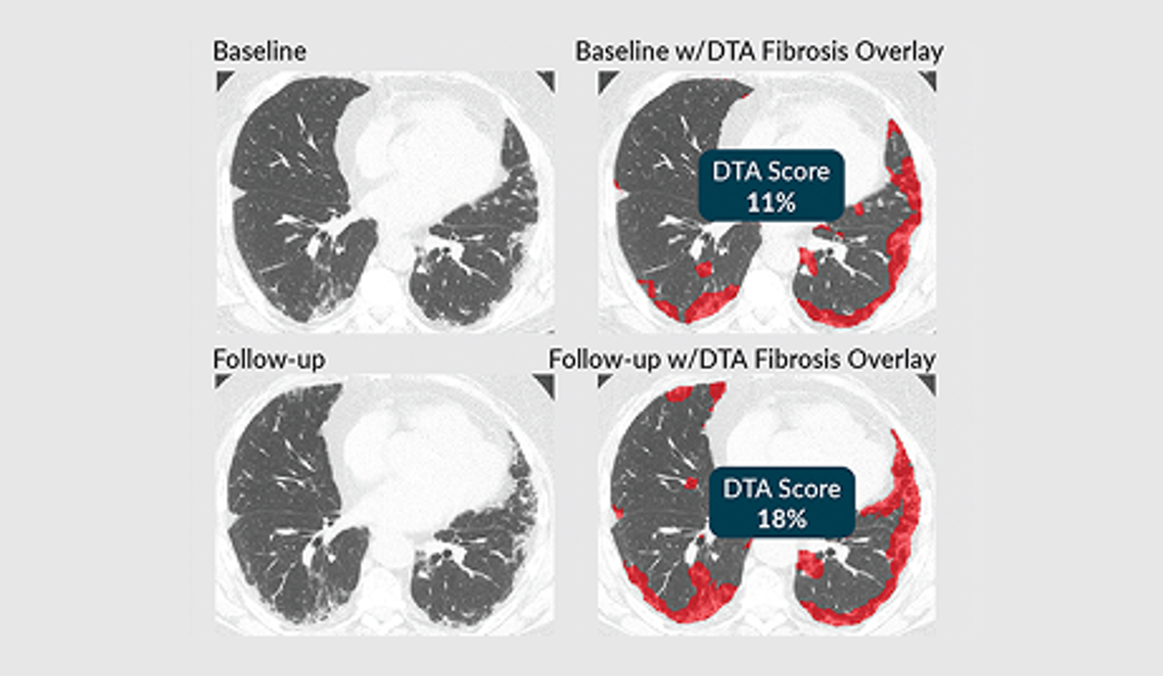 VIDA Extends Trial Imaging Platform with the Addition of Data-Driven Texture Analysis (DTA) Fibrosis Score for Interstitial Lung Disease (ILD)