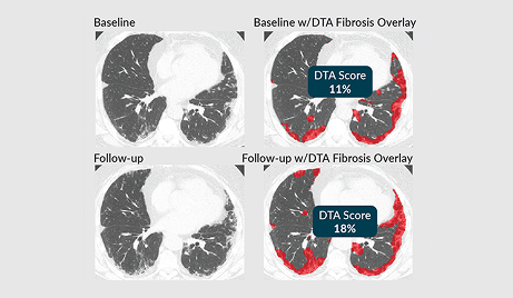 VIDA Extends Trial Imaging Platform with the Addition of Data-Driven Texture Analysis (DTA) Fibrosis Score for Interstitial Lung Disease (ILD)
