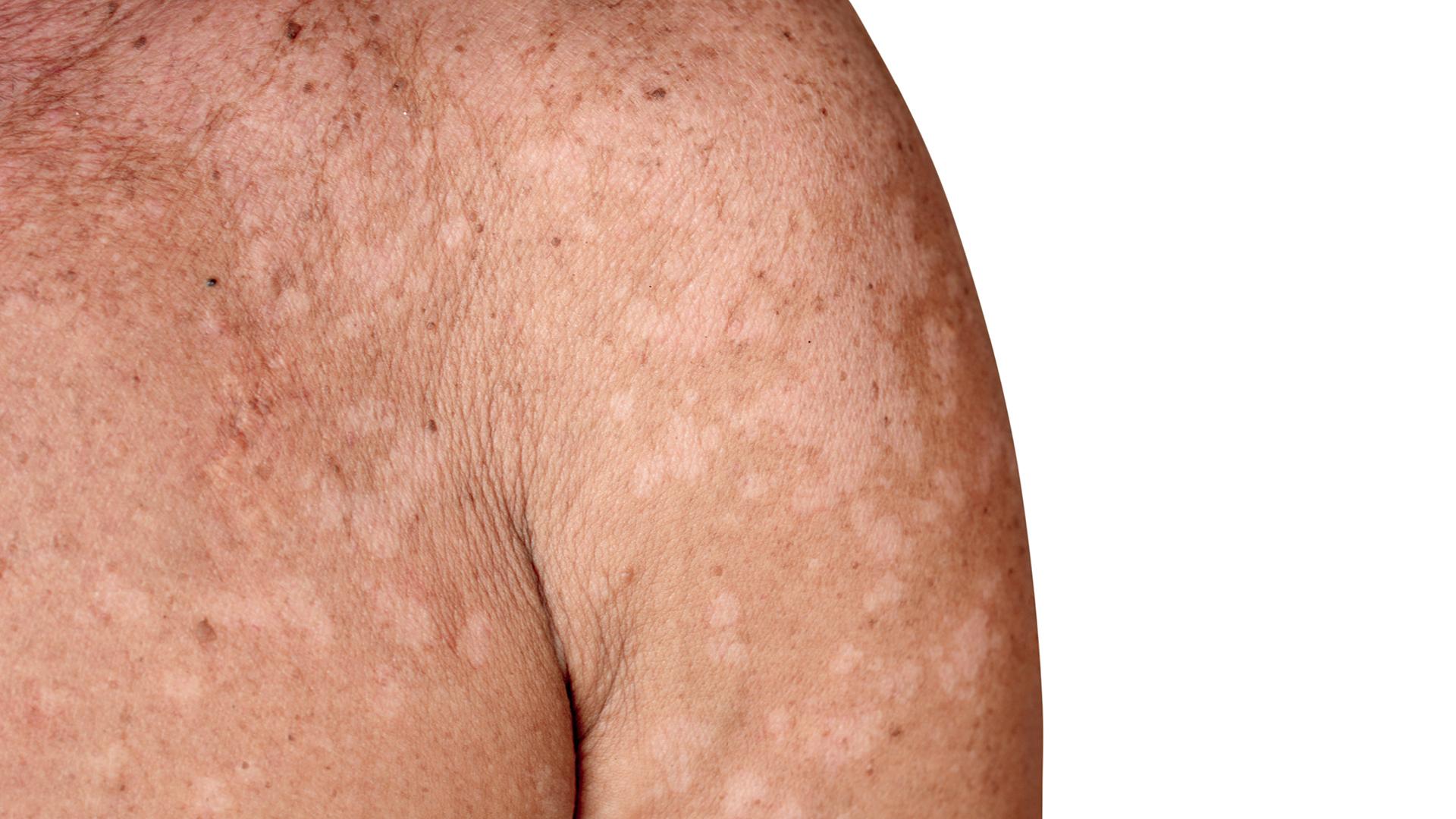 Close up of freckles and white spots on an older woman's shoulder