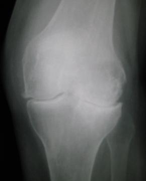 Osteoarthritis of the Hip and Knee — orthointerview.com