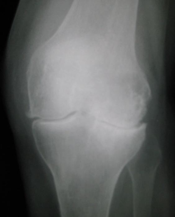Osteoarthritis of the Hip and Knee — orthointerview.com