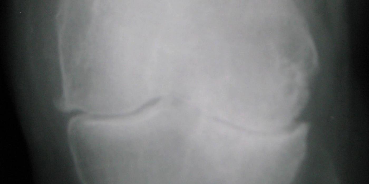 Osteoarthritis of the Hip and Knee — orthointerview.com