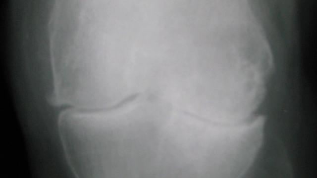 Osteoarthritis of the Hip and Knee — orthointerview.com