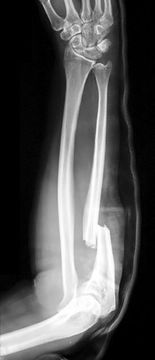 Forearm Fractures (including Open Injuries): Diagnosis and Management — orthointerview.com