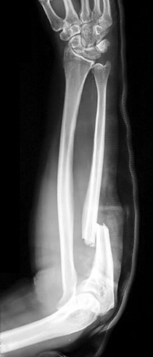 Forearm Fractures (including Open Injuries): Diagnosis and Management — orthointerview.com