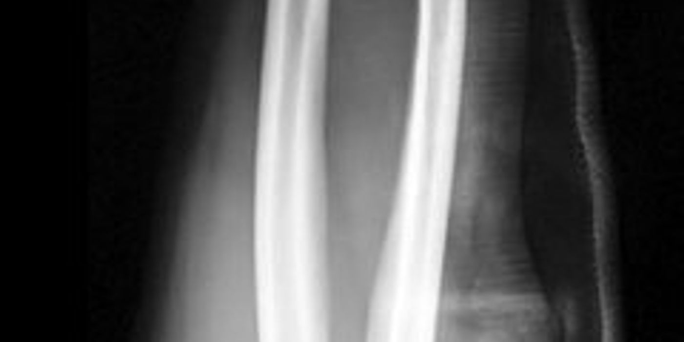 Forearm Fractures (including Open Injuries): Diagnosis and Management — orthointerview.com