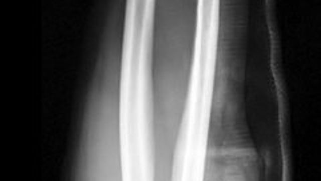 Forearm Fractures (including Open Injuries): Diagnosis and Management — orthointerview.com