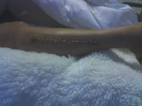 Acute Compartment Syndrome: Diagnosis and Management (Jul 2025 BOAST) — orthointerview.com