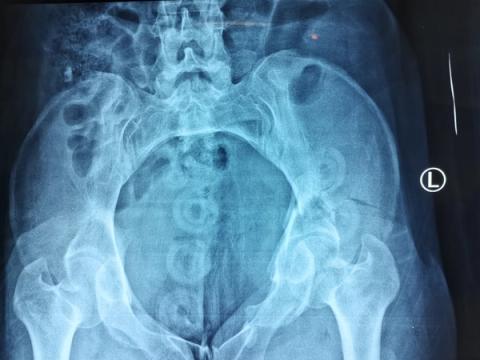 Pelvic Ring Injuries: Assessment, Haemorrhage Control and Definitive Management — orthointerview.com