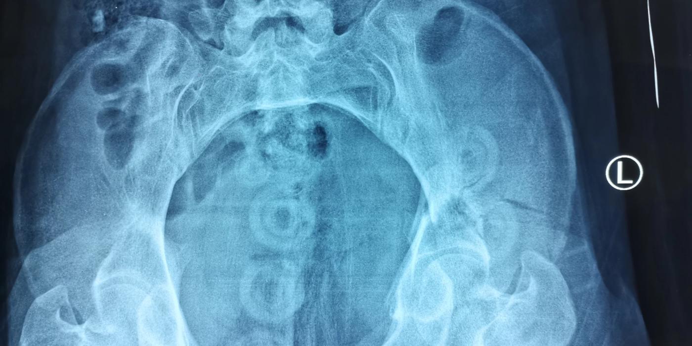 Pelvic Ring Injuries: Assessment, Haemorrhage Control and Definitive Management — orthointerview.com