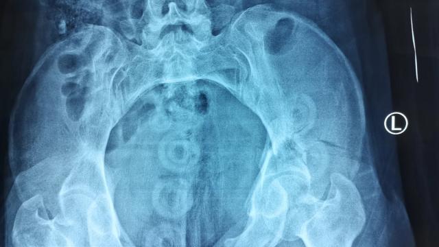 Pelvic Ring Injuries: Assessment, Haemorrhage Control and Definitive Management — orthointerview.com