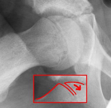 SUFE and Perthes' Disease: Classification, Management and Prognosis — orthointerview.com