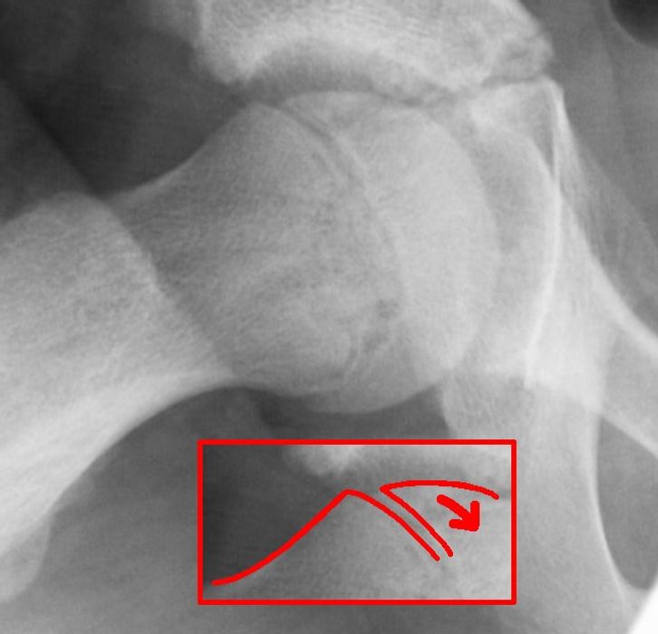 SUFE and Perthes' Disease: Classification, Management and Prognosis — orthointerview.com