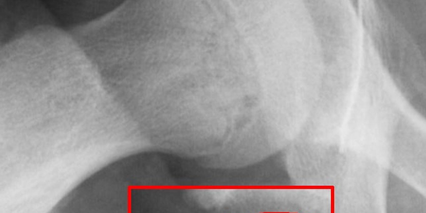 SUFE and Perthes' Disease: Classification, Management and Prognosis — orthointerview.com